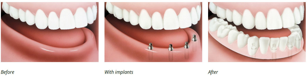 implant supported denture